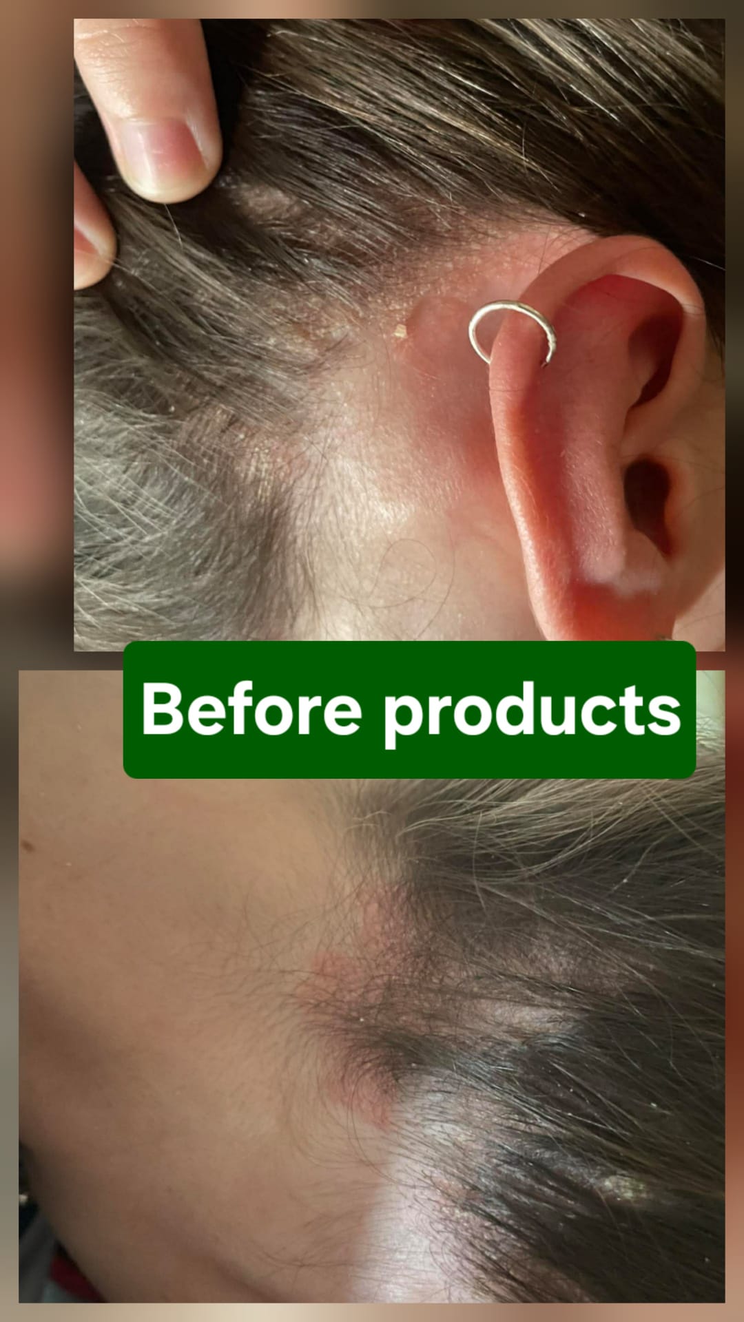 Genesis Comfort Care System - Sensitive Scalp Support