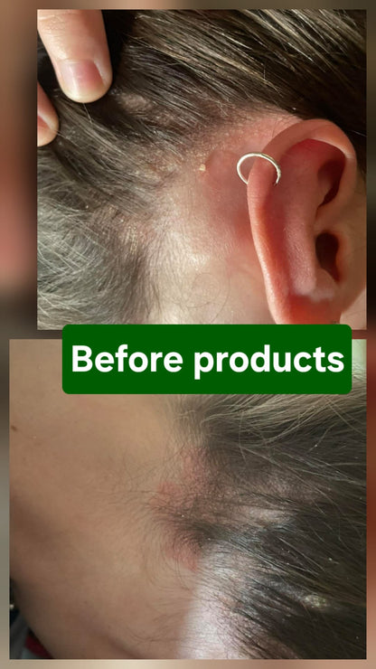 Genesis Comfort Care System - Sensitive Scalp Support