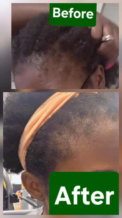 Genesis Hairline Reset System -(Phase 1)