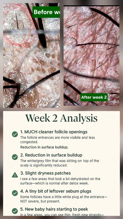 Genesis Scalp Reset System (Phase 1) - Best for Detox